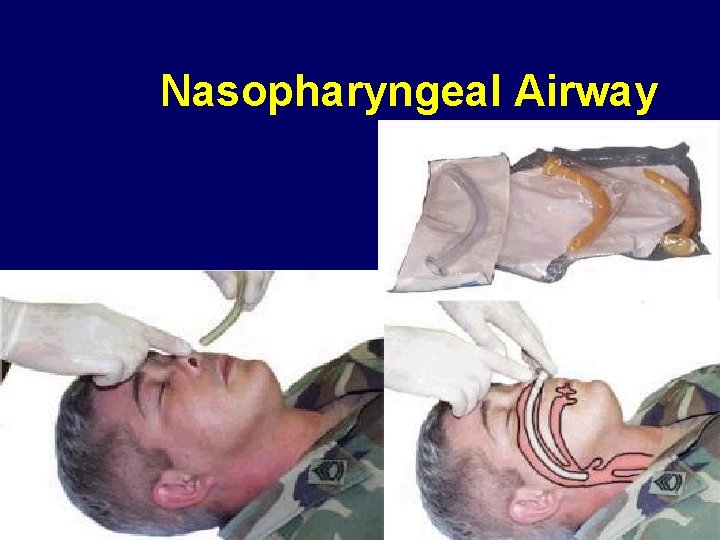 Nasopharyngeal Airway 