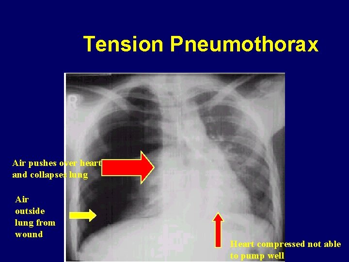 Tension Pneumothorax Air pushes over heart and collapses lung Air outside lung from wound
