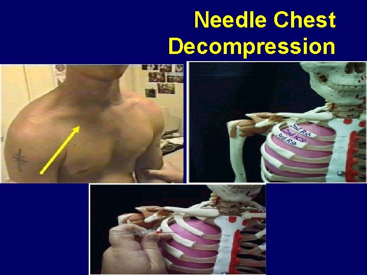 Needle Chest Decompression 
