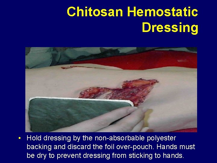 Chitosan Hemostatic Dressing • Hold dressing by the non-absorbable polyester backing and discard the