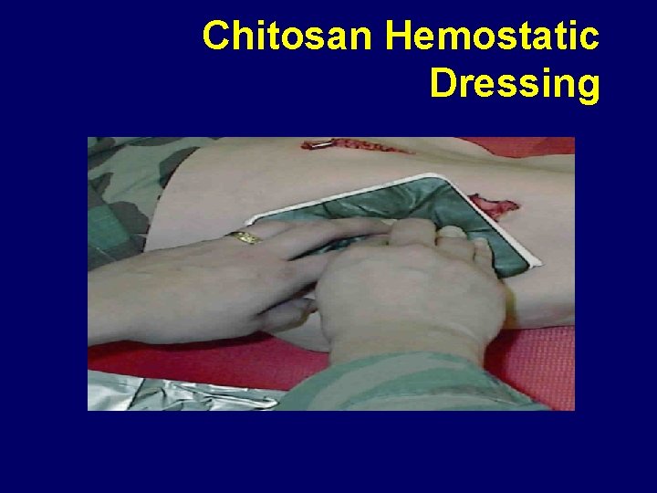 Chitosan Hemostatic Dressing 