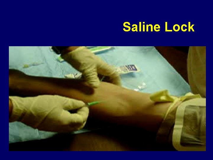 Saline Lock 