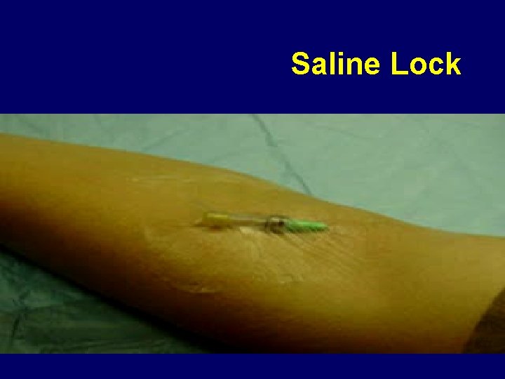 Saline Lock 