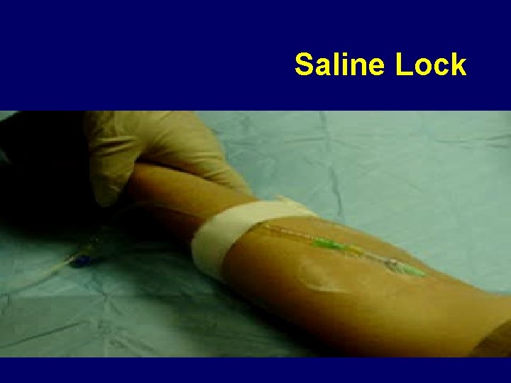 Saline Lock 