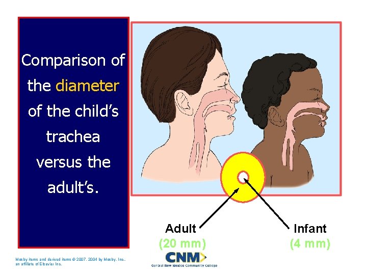 Comparison of the diameter of the child’s trachea versus the adult’s. Adult (20 mm)