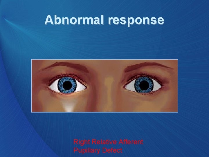 Abnormal response Right Relative Afferent Pupillary Defect 