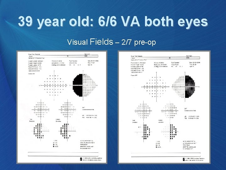 39 year old: 6/6 VA both eyes Visual Fields – 2/7 pre-op 