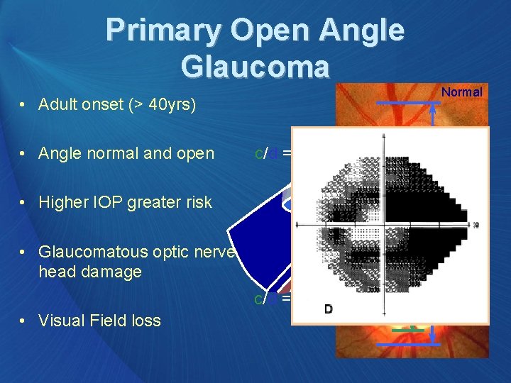 Primary Open Angle Glaucoma • Adult onset (> 40 yrs) • Angle normal and