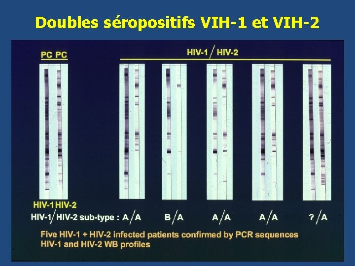 Doubles séropositifs VIH-1 et VIH-2 