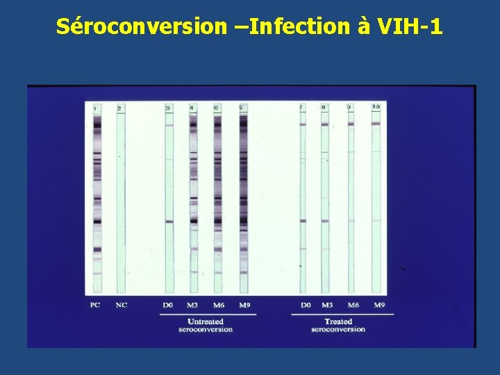 Séroconversion –Infection à VIH-1 