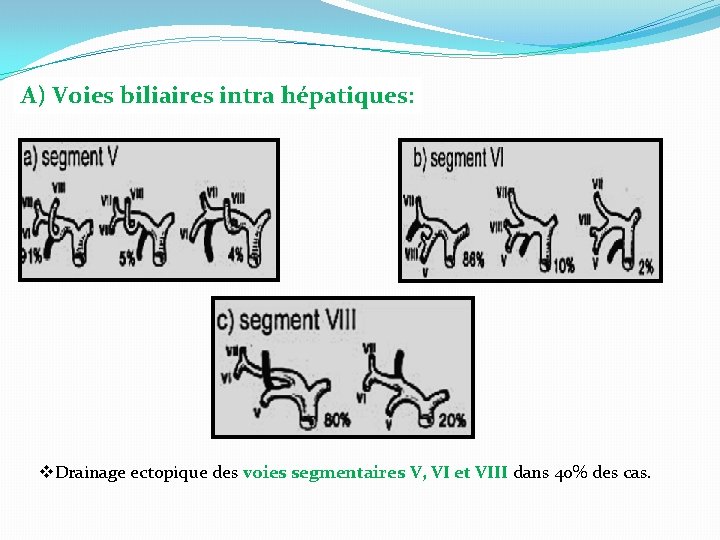 A) Voies biliaires intra hépatiques: v. Drainage ectopique des voies segmentaires V, VI et