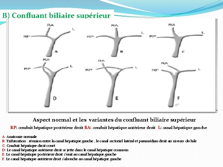 B) Confluant biliaire supérieur Aspect normal et les variantes du confluant biliaire supérieur RP: