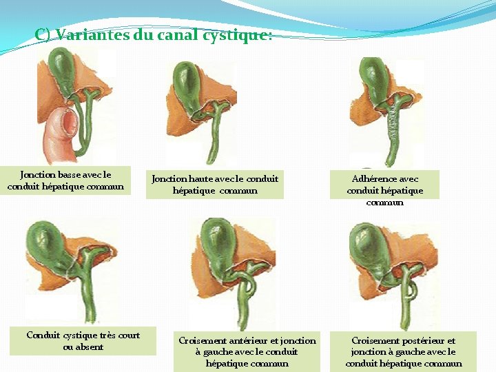 C) Variantes du canal cystique: Jonction basse avec le conduit hépatique commun Conduit cystique