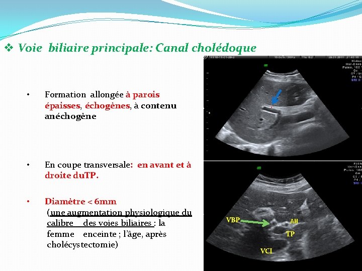 v Voie biliaire principale: Canal cholédoque • Formation allongée à parois épaisses, échogènes, à