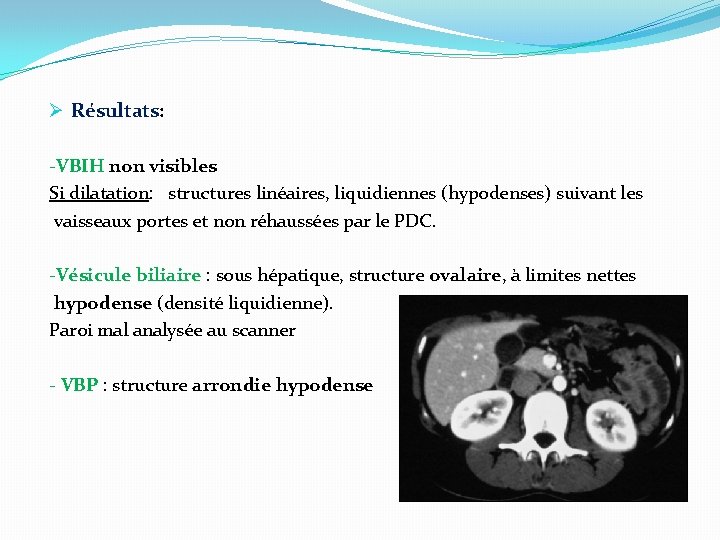 Ø Résultats: -VBIH non visibles Si dilatation: structures linéaires, liquidiennes (hypodenses) suivant les vaisseaux