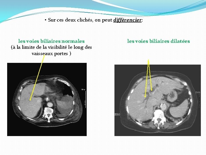  • Sur ces deux clichés, on peut différencier: les voies biliaires normales (à