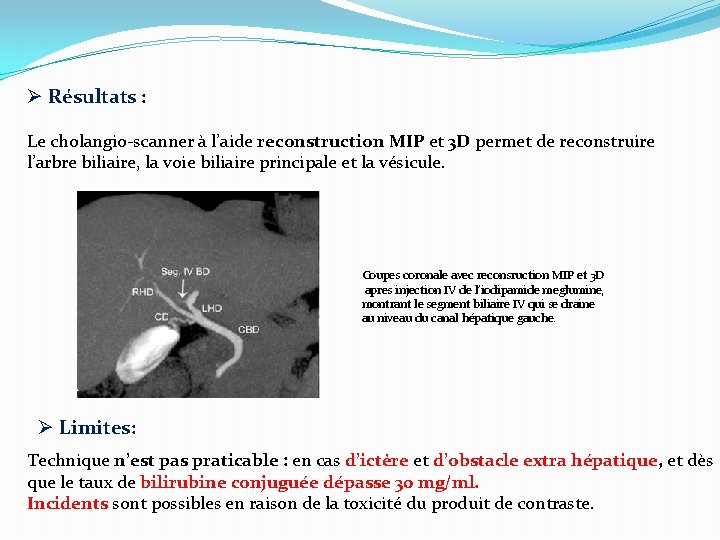 Ø Résultats : Le cholangio-scanner à l’aide reconstruction MIP et 3 D permet de