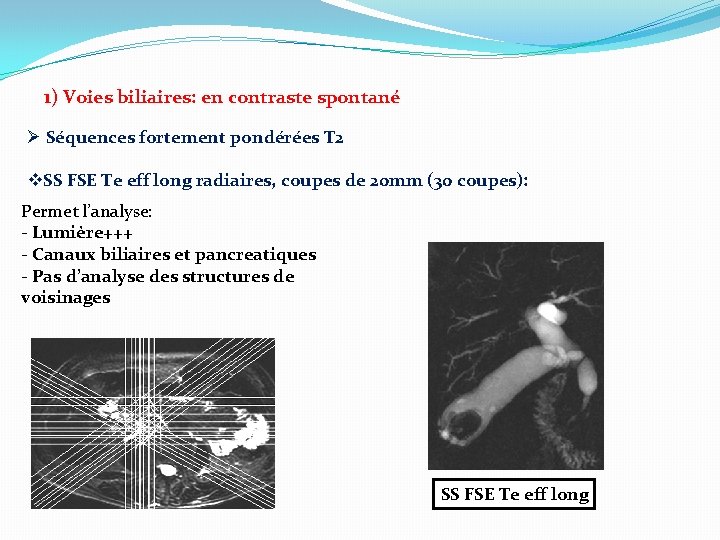  1) Voies biliaires: en contraste spontané Ø Séquences fortement pondérées T 2 v.
