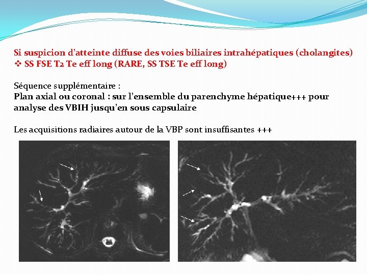 Si suspicion d’atteinte diffuse des voies biliaires intrahépatiques (cholangites) v SS FSE T 2