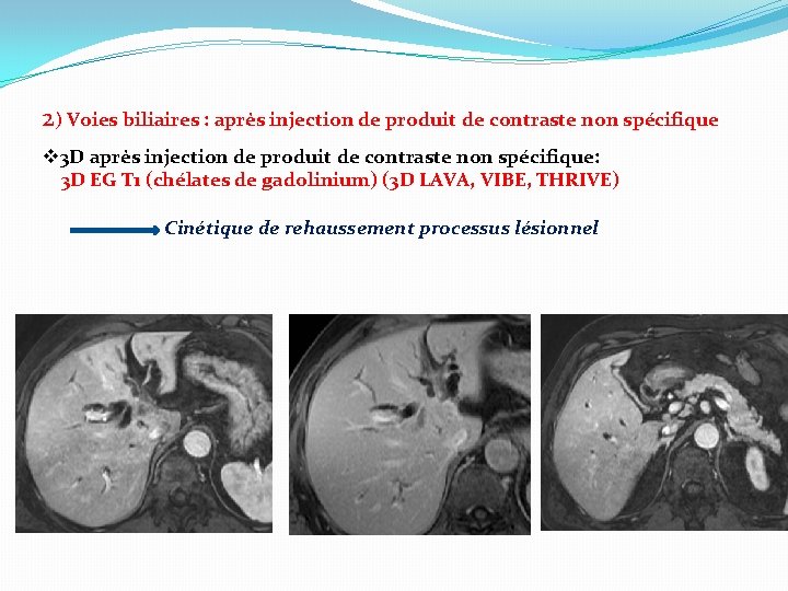 2) Voies biliaires : après injection de produit de contraste non spécifique v 3