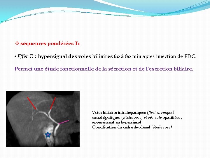 v séquences pondérées T 1 • Effet T 1 : hypersignal des voies biliaires