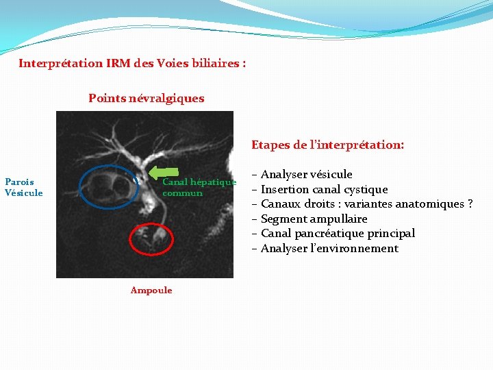 Interprétation IRM des Voies biliaires : Points névralgiques Etapes de l’interprétation: Parois Vésicule Canal