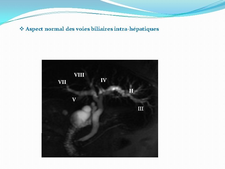 v Aspect normal des voies biliaires intra-hépatiques VIII VII IV III 