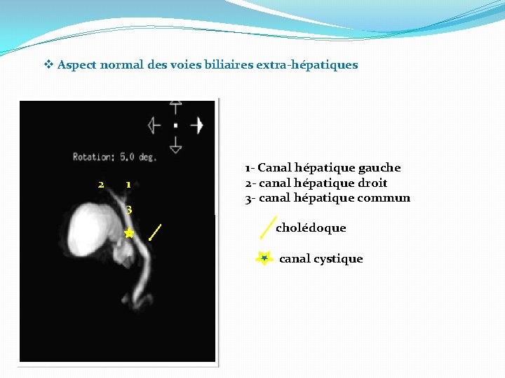 v Aspect normal des voies biliaires extra-hépatiques 2 1 3 1 - Canal hépatique