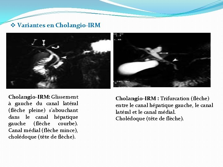 v Variantes en Cholangio-IRM: Glissement à gauche du canal latéral (flèche pleine) s’abouchant dans
