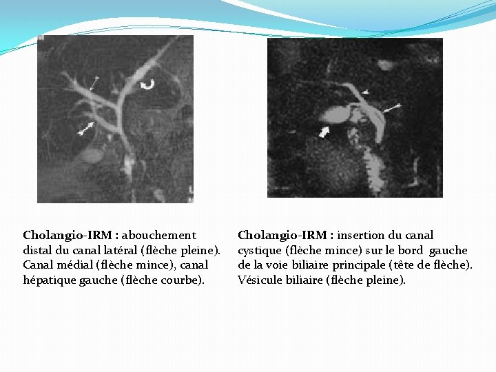 Cholangio-IRM : abouchement distal du canal latéral (flèche pleine). Canal médial (flèche mince), canal