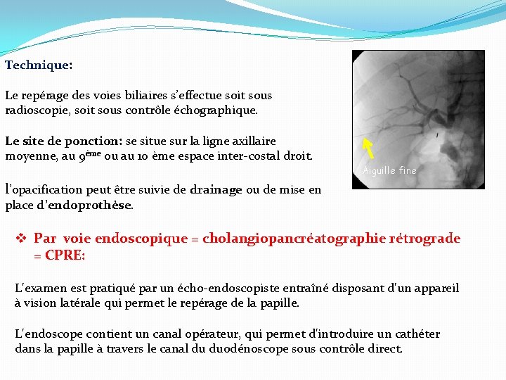 Technique: Le repérage des voies biliaires s’effectue soit sous radioscopie, soit sous contrôle échographique.