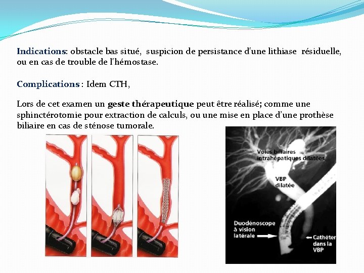 Indications: obstacle bas situé, suspicion de persistance d'une lithiase résiduelle, ou en cas de