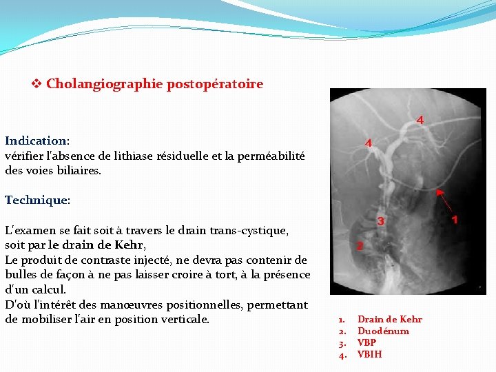 v Cholangiographie postopératoire Indication: vérifier l'absence de lithiase résiduelle et la perméabilité des voies