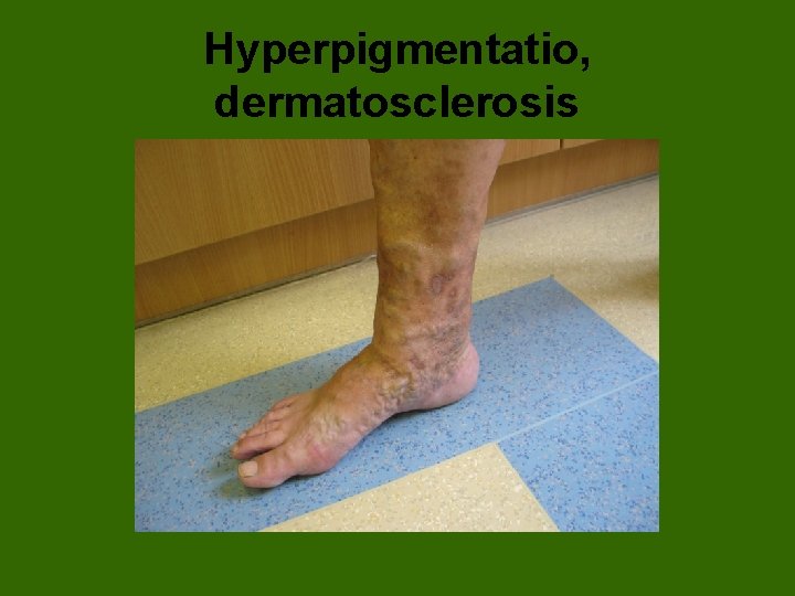 Hyperpigmentatio, dermatosclerosis 