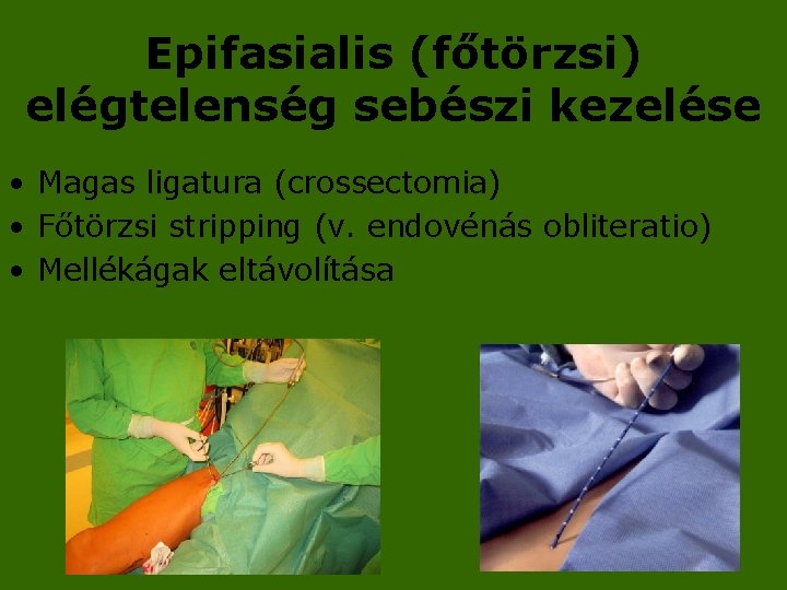 Epifasialis (főtörzsi) elégtelenség sebészi kezelése • Magas ligatura (crossectomia) • Főtörzsi stripping (v. endovénás