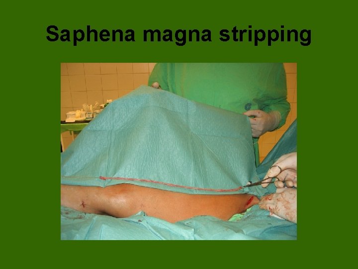 Saphena magna stripping 