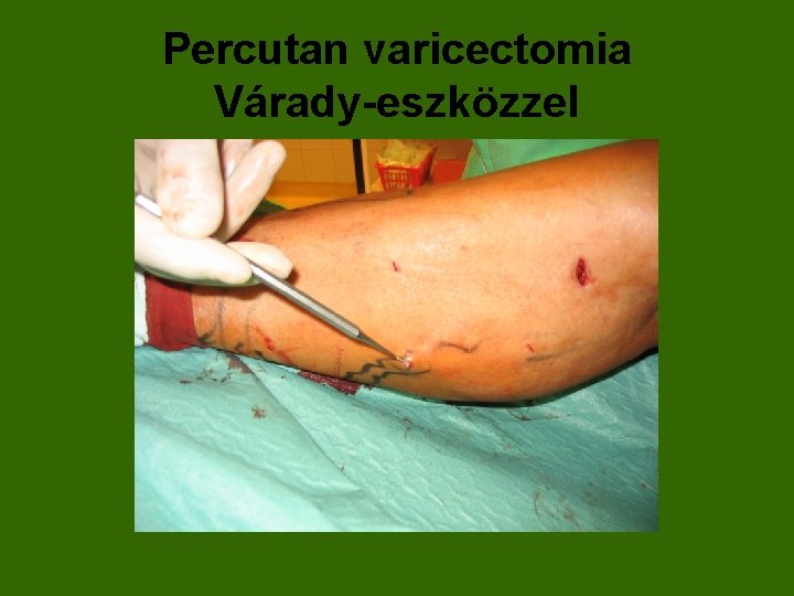 Percutan varicectomia Várady-eszközzel 