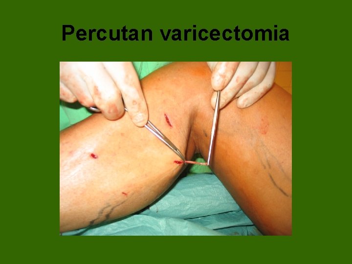 Percutan varicectomia 