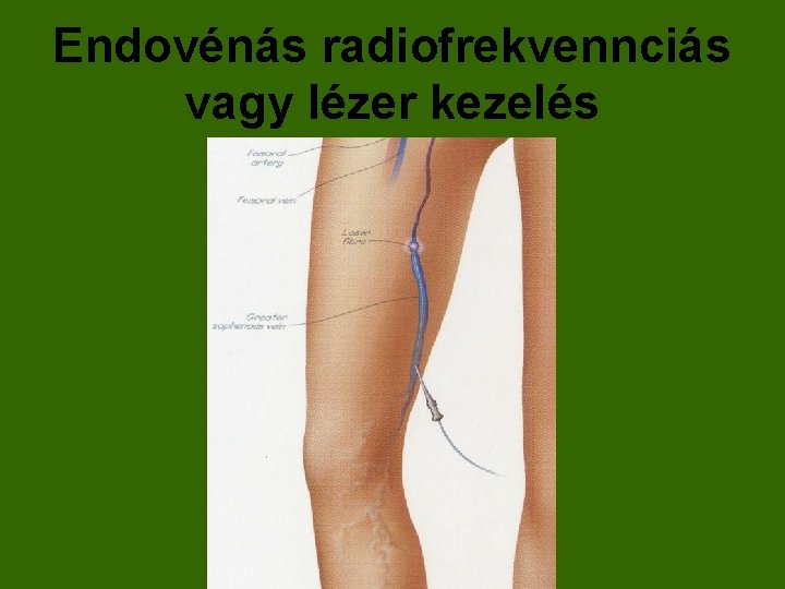 Endovénás radiofrekvennciás vagy lézer kezelés 