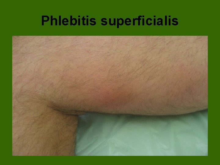 Phlebitis superficialis 