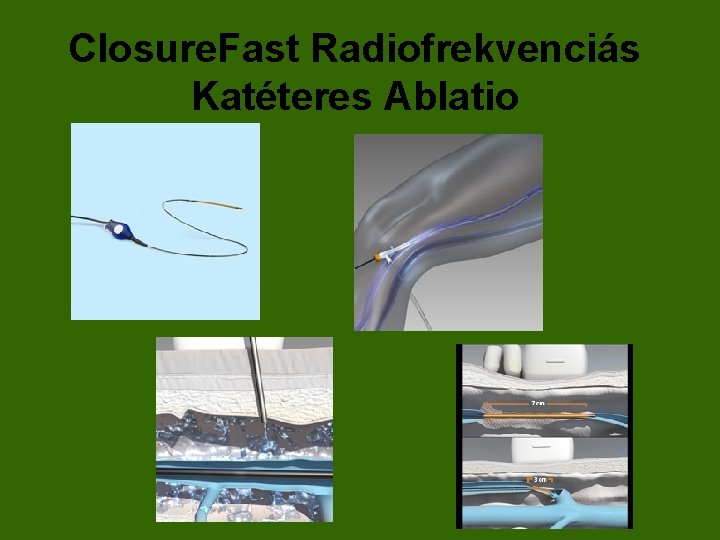 Closure. Fast Radiofrekvenciás Katéteres Ablatio 