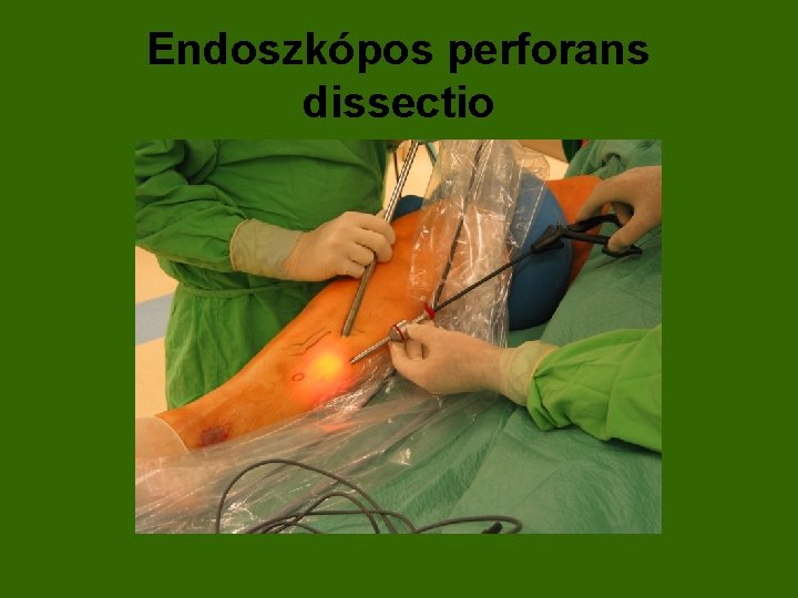 Endoszkópos perforans dissectio 