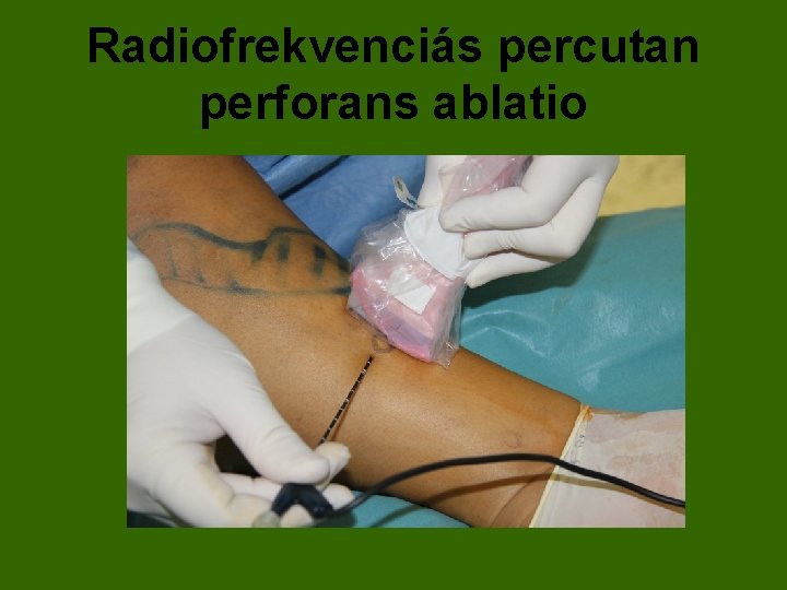 Radiofrekvenciás percutan perforans ablatio 