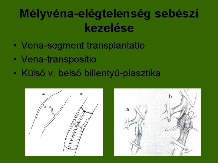 Mélyvéna-elégtelenség sebészi kezelése • Vena-segment transplantatio • Vena-transpositio • Külső v. belső billentyű-plasztika 