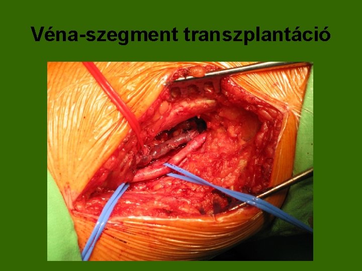 Véna-szegment transzplantáció 