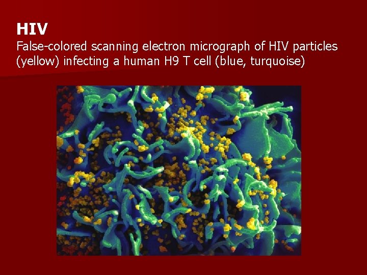 HIV False-colored scanning electron micrograph of HIV particles (yellow) infecting a human H 9