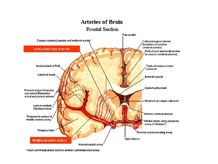 Lenticulostriate arteries Middle cerebral artery Lenticulostriate arteries Middle cerebral artery