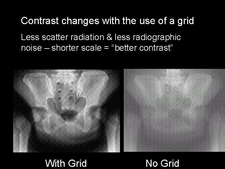 Contrast changes with the use of a grid Less scatter radiation & less radiographic