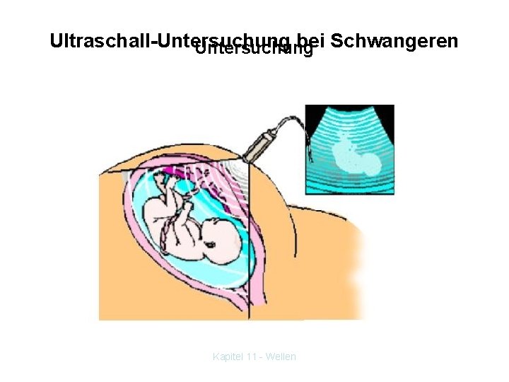 Ultraschall-Untersuchung bei Schwangeren Untersuchung Kapitel 11 - Wellen 