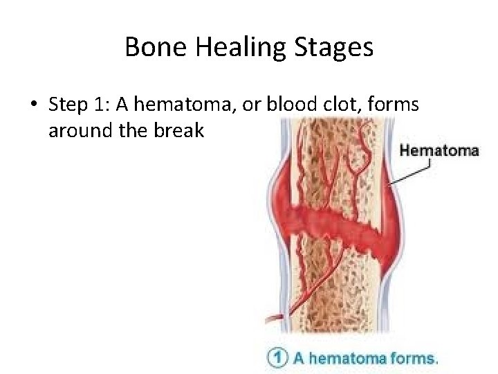 Bone Healing Stages • Step 1: A hematoma, or blood clot, forms around the